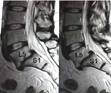 Espondilolistesis L5-S1. Desplazamiento de la quinta vértebra lumbsr sobre la primera vértebra sacra.