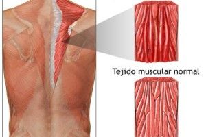 Lee más sobre el artículo Distensión muscular, una molestia dolorosa