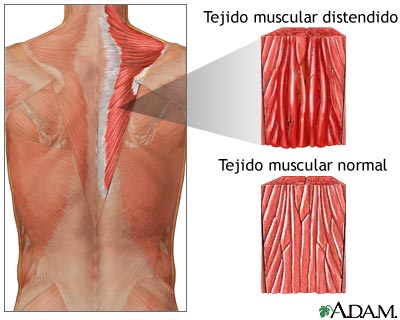 Distensión muscular, una molestia dolorosa 2