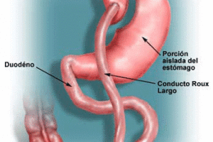 Lee más sobre el artículo Cirugías de la obesidad