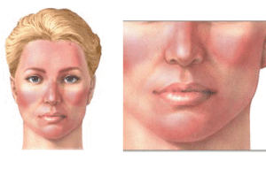Lee más sobre el artículo Psoriasis, síntomas y tratamiento