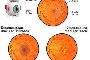 Lee más sobre el artículo La degeneración macular