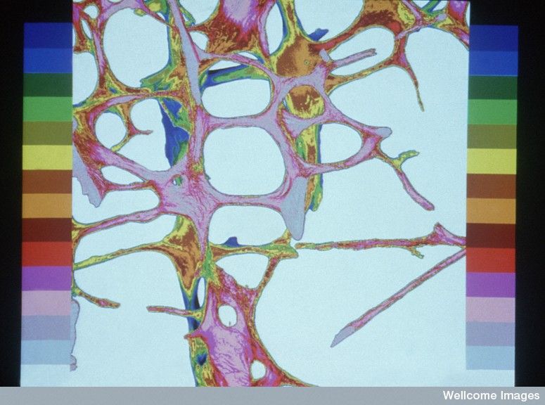 Lee más sobre el artículo Osteoporosis, beneficios del ejercicio físico