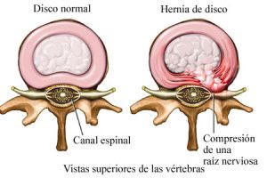 Lee más sobre el artículo Hernia de disco