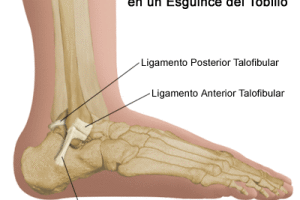 Lee más sobre el artículo Esguince de Tobillo, una lesión muy común