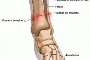 Lee más sobre el artículo Las fracturas por stress