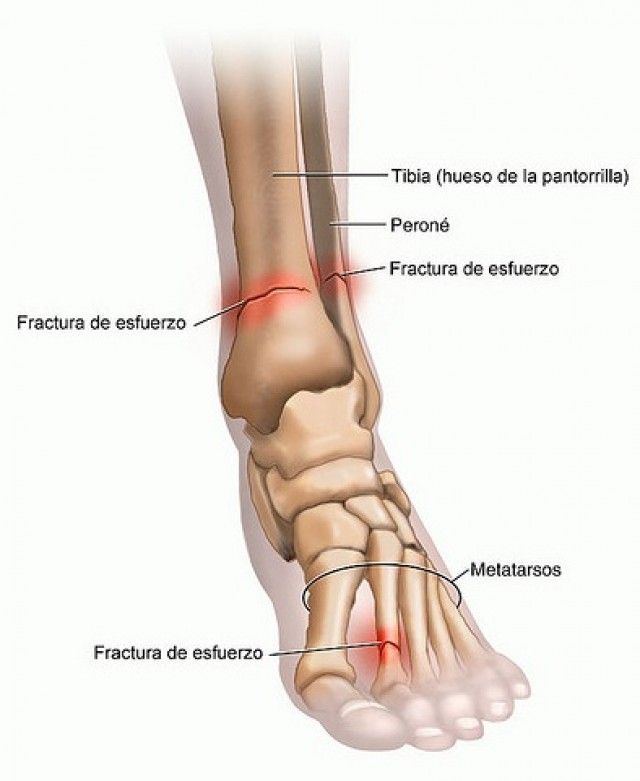 Lee más sobre el artículo Las fracturas por stress
