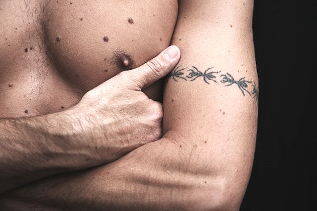 Lee más sobre el artículo Cómo reconocer un lunar de un melanoma