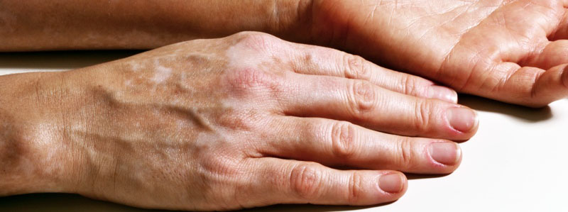 Opciones de tratamiento para el vitíligo: recuperando la piel y la confianza 1